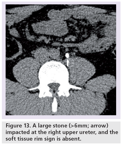 imaging-in-medicine-large-stone