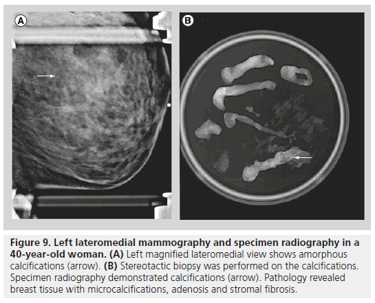 imaging-in-medicine-lateromedial-mammography