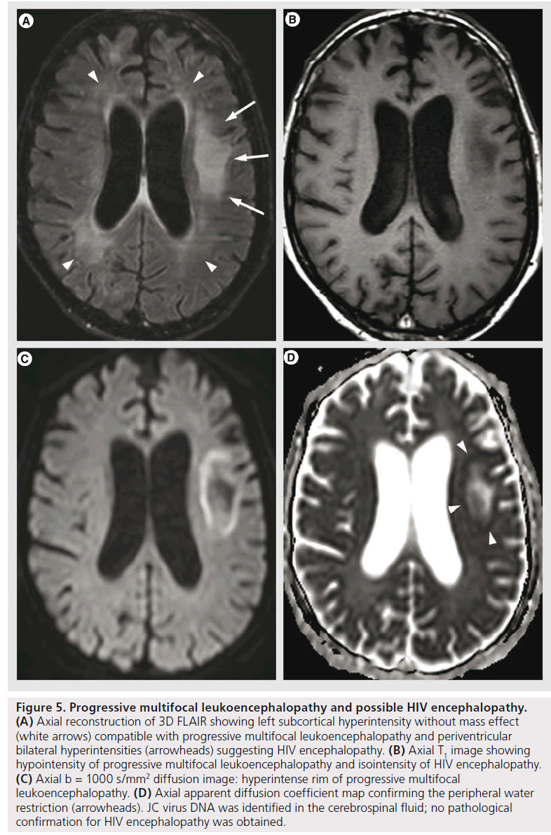 imaging-in-medicine-leukoencephalopathy-possible