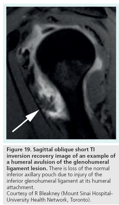 imaging-in-medicine-ligament-lesion