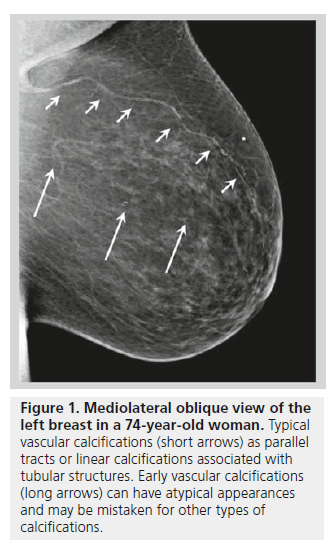 imaging-in-medicine-linear-calcifications