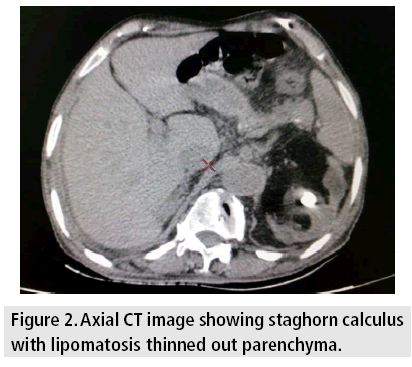 imaging-in-medicine-lipomatosis-thinned