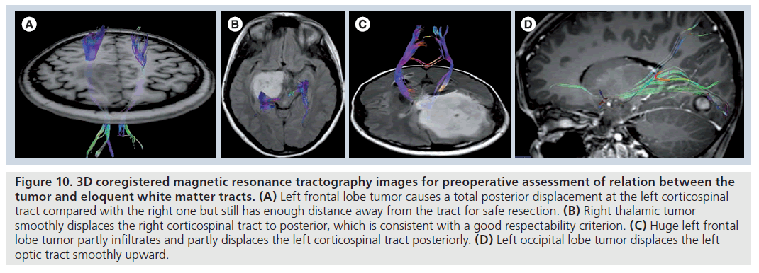 imaging-in-medicine-lobe-tumor