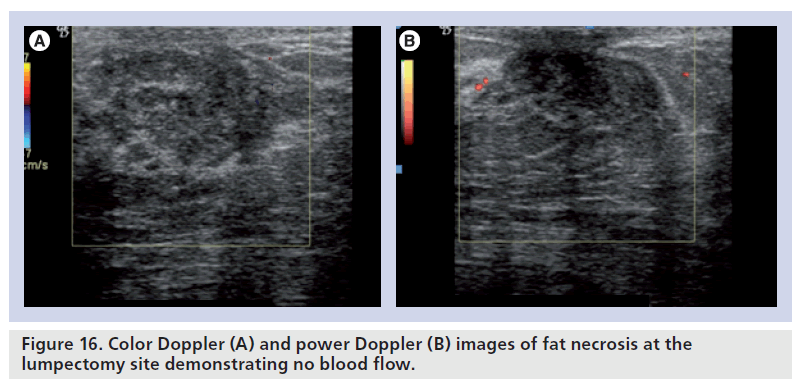 imaging-in-medicine-lumpectomy-site