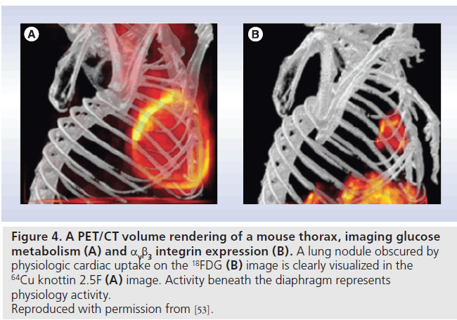 imaging-in-medicine-lung-nodule