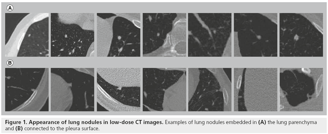 imaging-in-medicine-lung-nodules