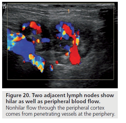 Doppler Ultrasound Color Chart