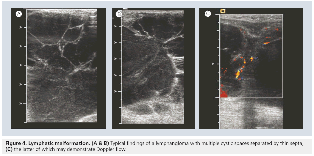 imaging-in-medicine-lymphangioma