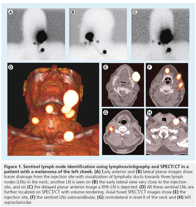 imaging-in-medicine-lymphoscintigraphy