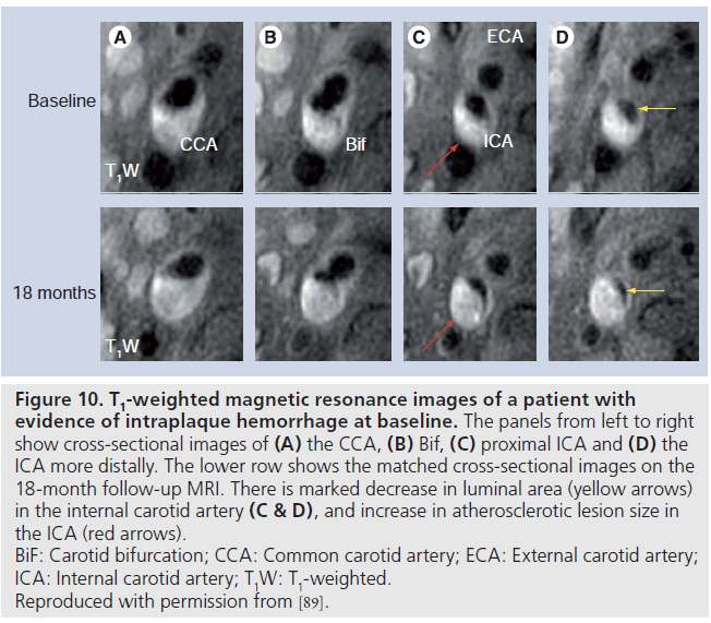 MRI in the early identification and classification of high-risk a