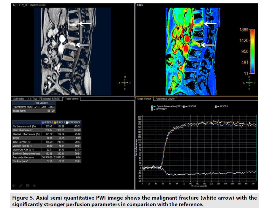imaging-in-medicine-malignant-fracture