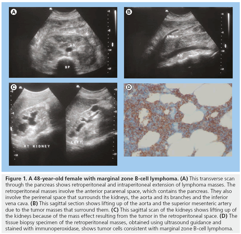 imaging-in-medicine-marginal-zone