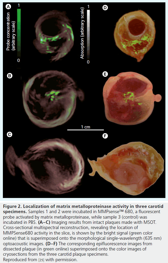 imaging-in-medicine-matrix-metalloproteinase