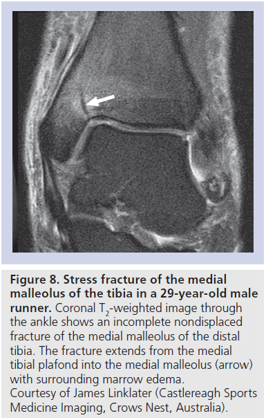 imaging-in-medicine-medial-malleolus