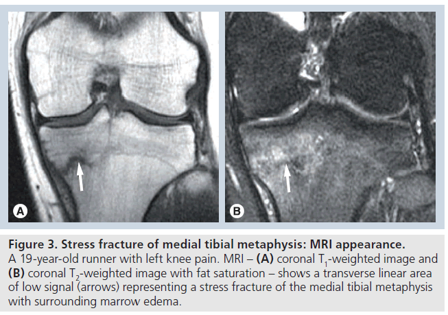 Tibial plateau stress fracture running