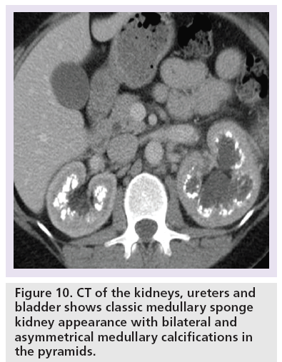 imaging-in-medicine-medullary-sponge