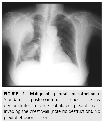 imaging in medicine mesothelioma 8 1 15 g002