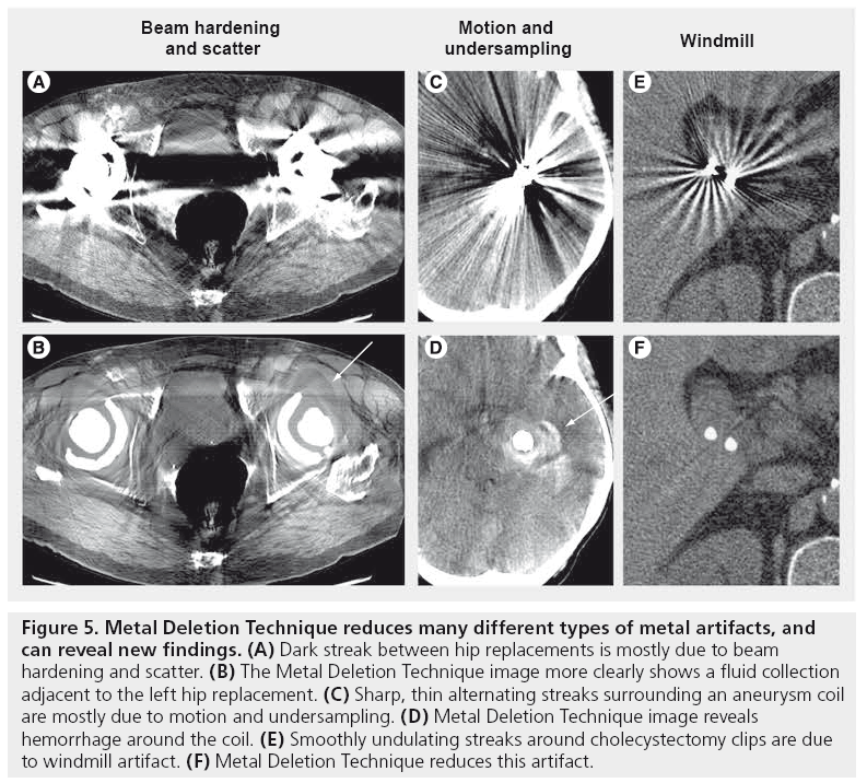 imaging-in-medicine-metal-artifacts