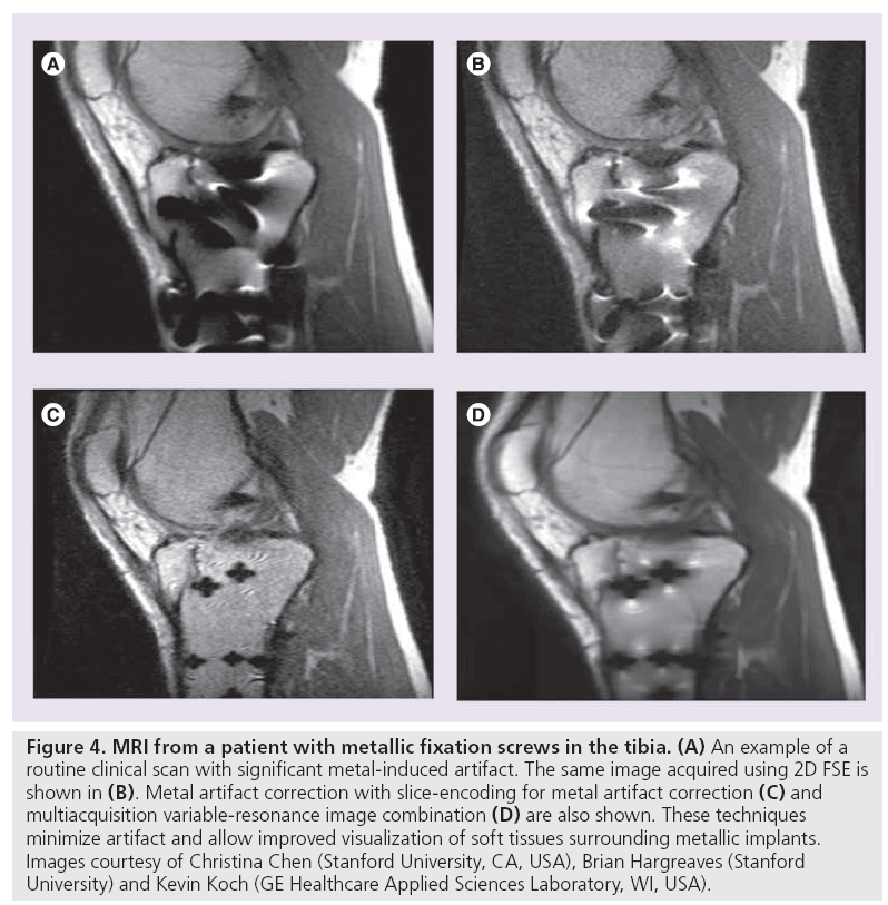 imaging-in-medicine-metallic-fixation