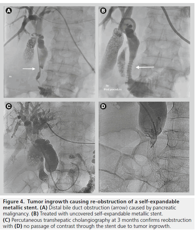imaging-in-medicine-metallic-stent