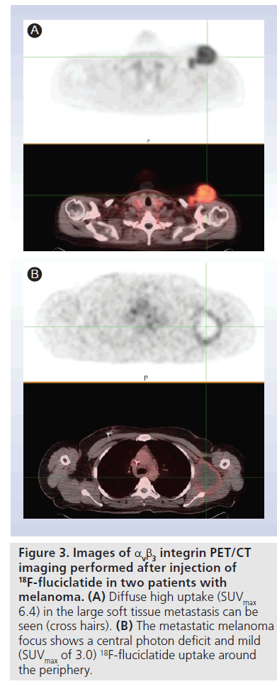 imaging-in-medicine-metastatic-melanoma