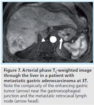 imaging-in-medicine-metastatic-retrocaval