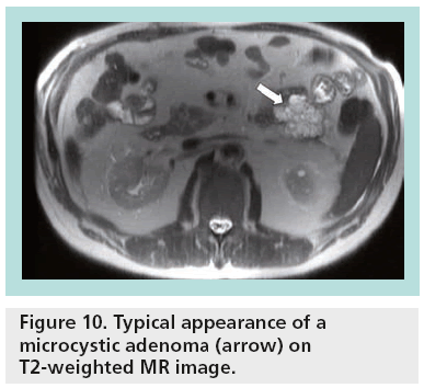 imaging-in-medicine-microcystic-adenoma