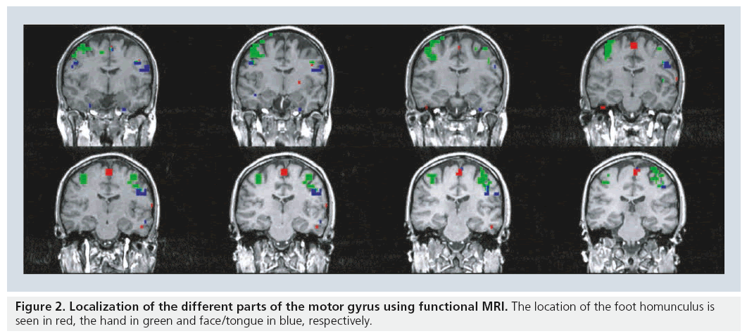 imaging-in-medicine-motor-gyrus