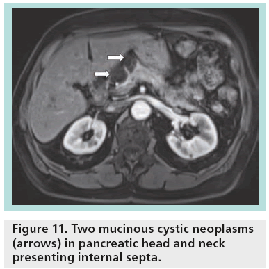 imaging-in-medicine-mucinous-cystic