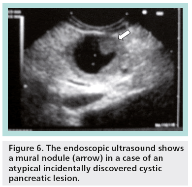 imaging-in-medicine-mural-nodule