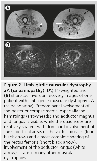 imaging-in-medicine-muscular-dystrophy