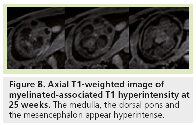 imaging-in-medicine-myelinated-associated