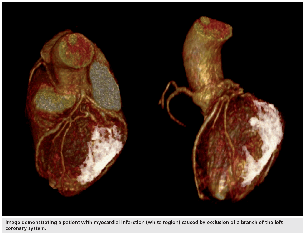 imaging-in-medicine-myocardial-infarction