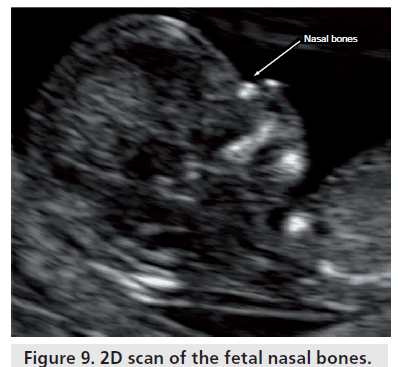 imaging-in-medicine-nasal-bones