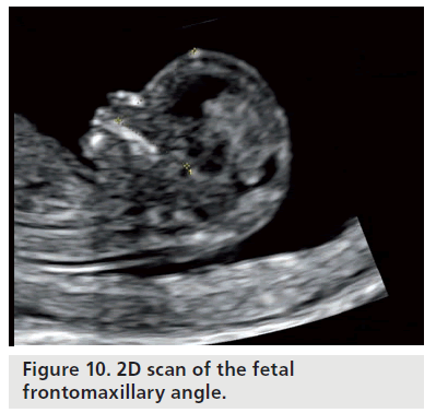 imaging-in-medicine-nasal-bones