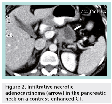 imaging-in-medicine-necrotic