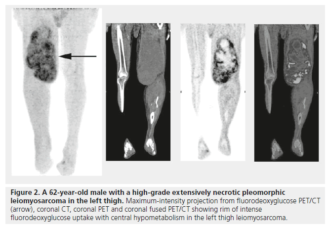 imaging-in-medicine-necrotic-pleomorphic