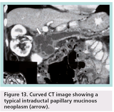 imaging-in-medicine-neoplasm