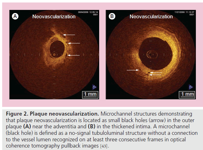 imaging-in-medicine-neovascularization-Microchannel