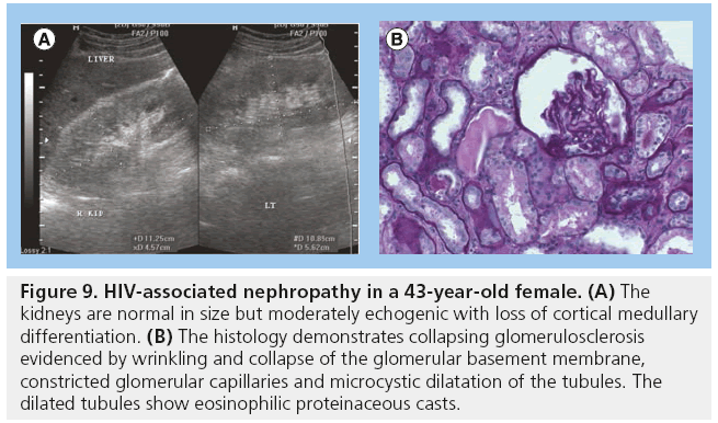 imaging-in-medicine-nephropathy