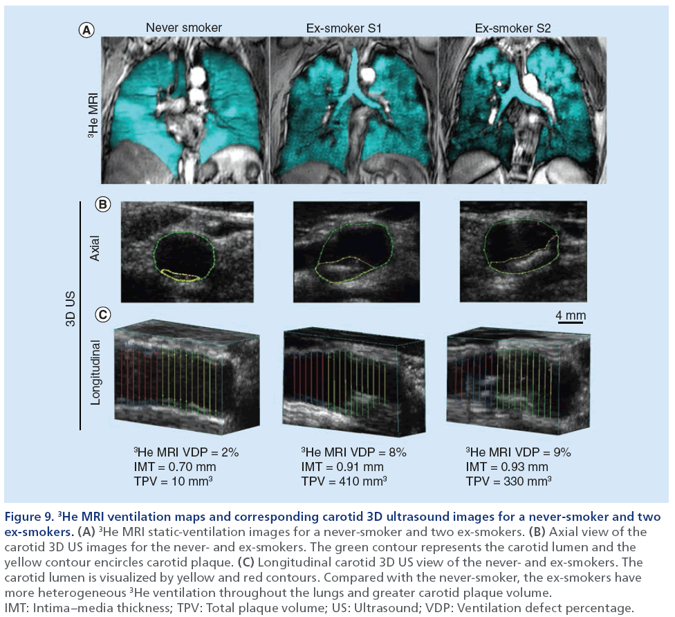 imaging-in-medicine-never-smoker