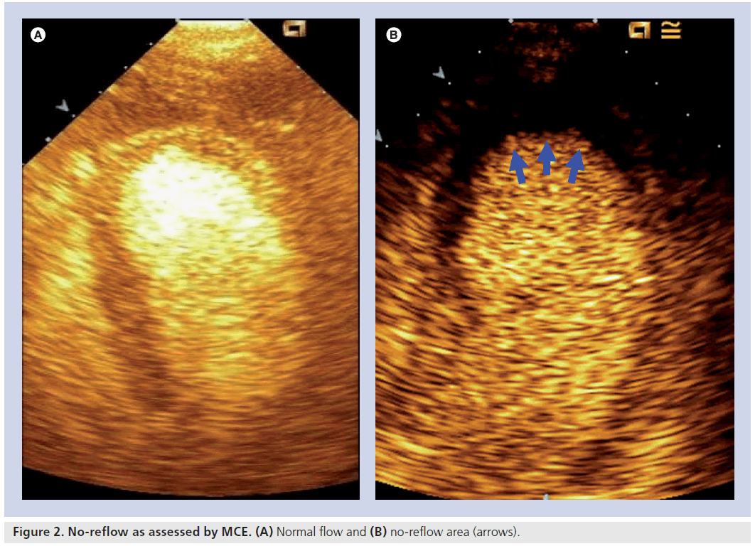 imaging-in-medicine-no-reflow