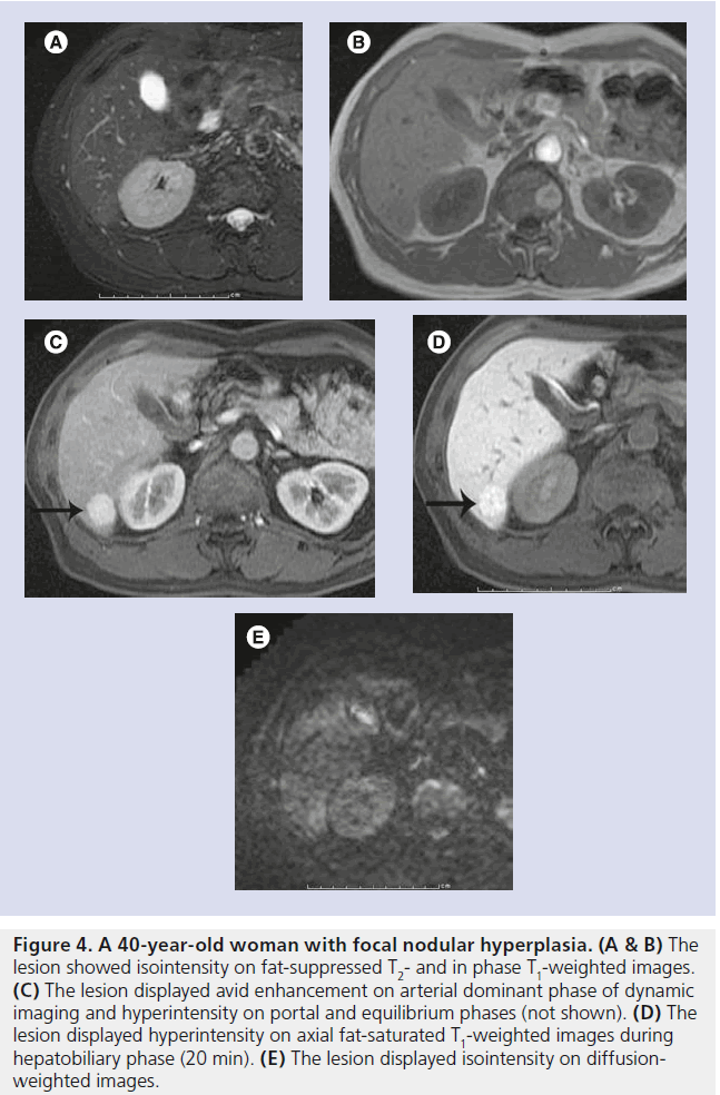 imaging-in-medicine-nodular-hyperplasia