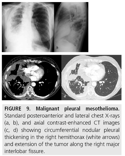 Mesothelioma Ct Scan Example Of A Patient With Right Sided Mpm