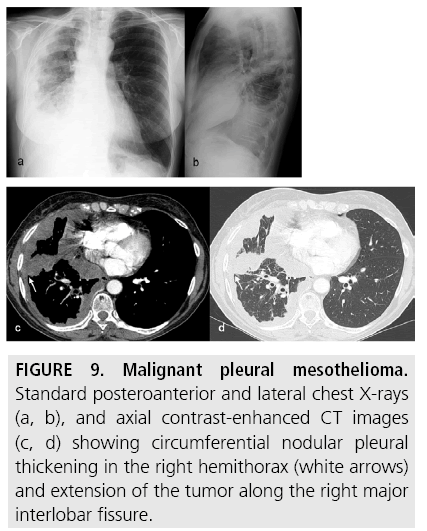 imaging-in-medicine-nodular-pleural