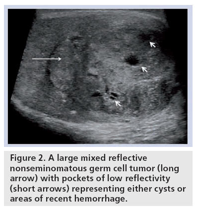 imaging-in-medicine-nonseminomatous