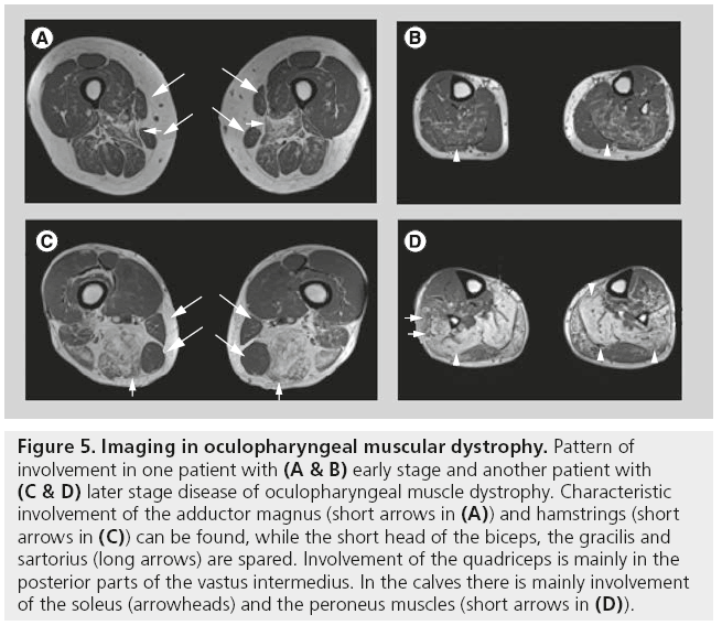 imaging-in-medicine-oculopharyngeal