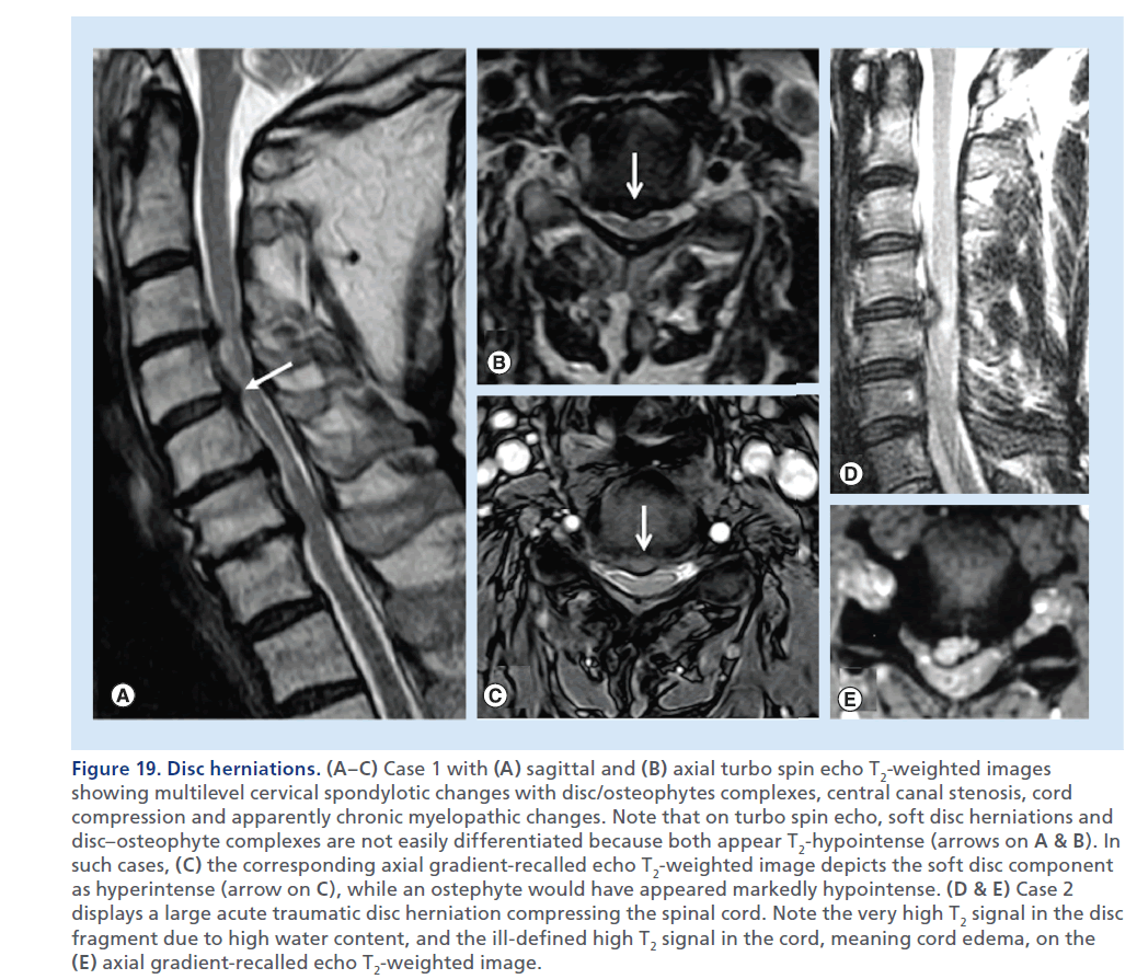 imaging-in-medicine-osteophytes–complexes