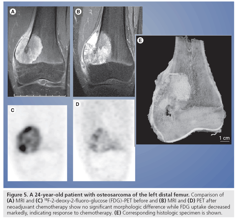 can you have radiation for lung cancer