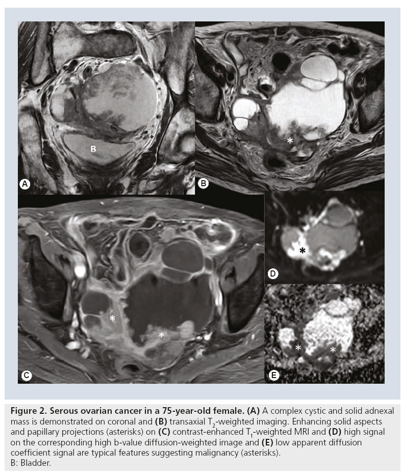 imaging-in-medicine-ovarian-cancer